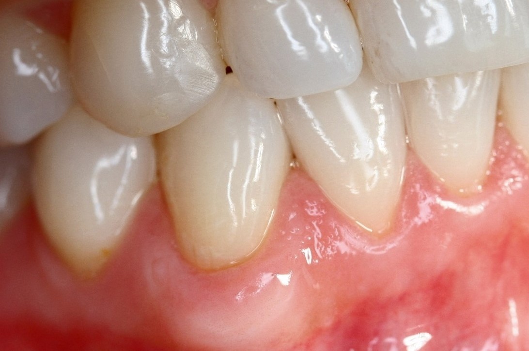 Periodontal Treatments Mountainview Dental Centre North Vancouver BC